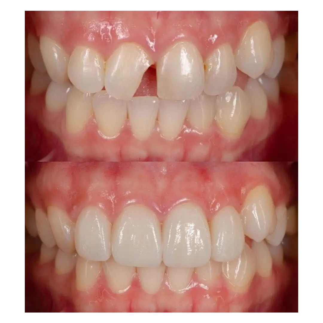 Before and after veneers showing whiter teeth and a fixed chipped tooth 